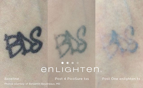 Enlighten Tattoo Removal Laser