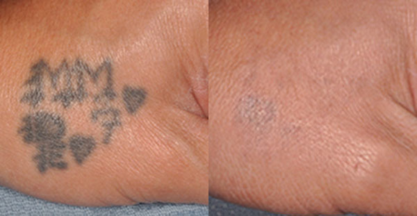 Enlighten Tattoo Removal Laser Before and After Photo by Dr. Wang in Los Angeles, CA