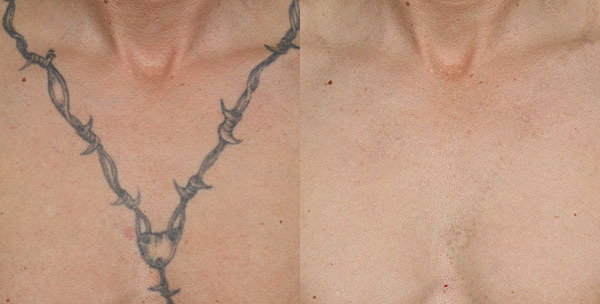 Enlighten Tattoo Removal Laser Before and After Photo by Dr. Wang in Los Angeles, CA