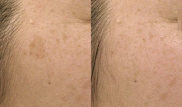 Pico Genesis Before and After Photo by Dr. Wang in Los Angeles, CA