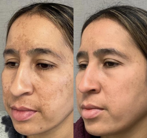 Spectra FX Laser Before and After Photo by Dr. James Y. Wang of Metropolis Dermatology in Los Angeles, CA