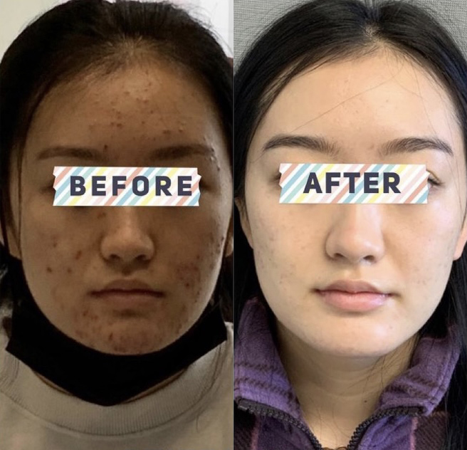 Acne Treatment Before and After Photo by Dr. James Y. Wang of Metropolis Dermatology in Los Angeles, CA