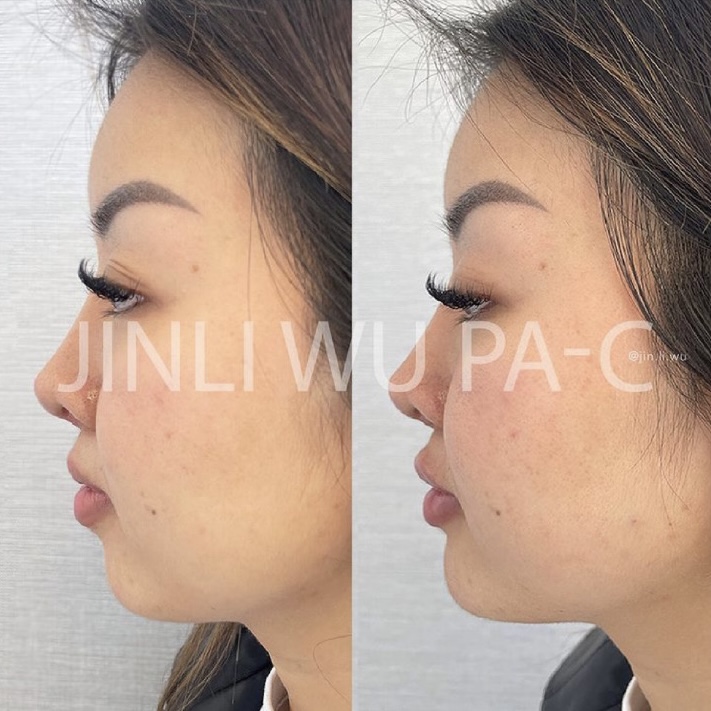 Chin Filler Before and After Photo by Dr. James Y. Wang of Metropolis Dermatology in Los Angeles, CA