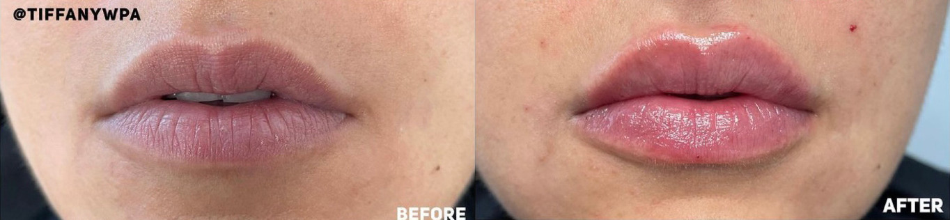 Lip Filler Before and After Photo by Dr. James Y. Wang of Metropolis Dermatology in Los Angeles, CA