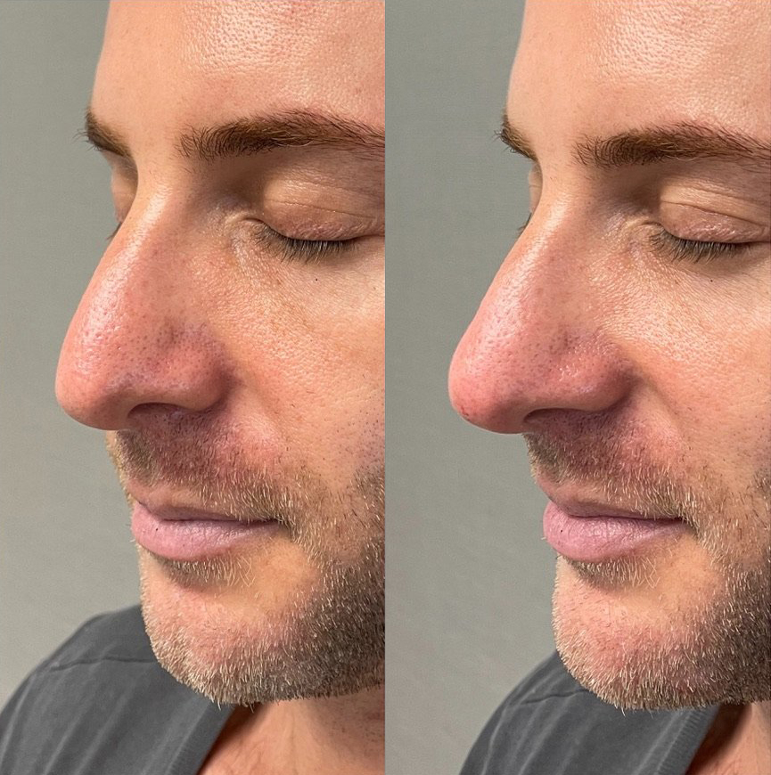 Liquid Rhinoplasty Before and After Photo by Dr. James Y. Wang of Metropolis Dermatology in Los Angeles, CA