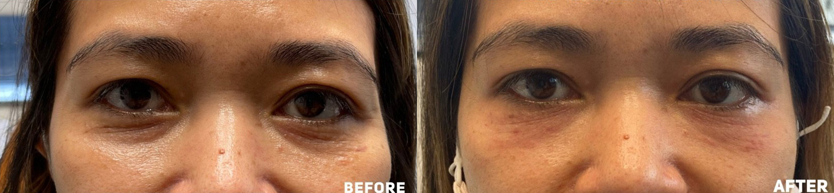 Under Eye PRP Before and After Photo by Dr. James Y. Wang of Metropolis Dermatology in Los Angeles, CA