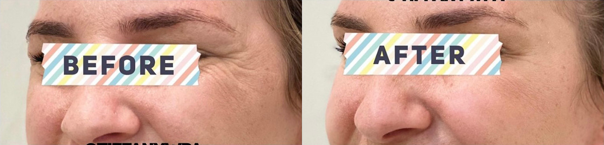 Botox for Crows Feet Before and After Photo by Dr. James Y. Wang of Metropolis Dermatology in Los Angeles, CA