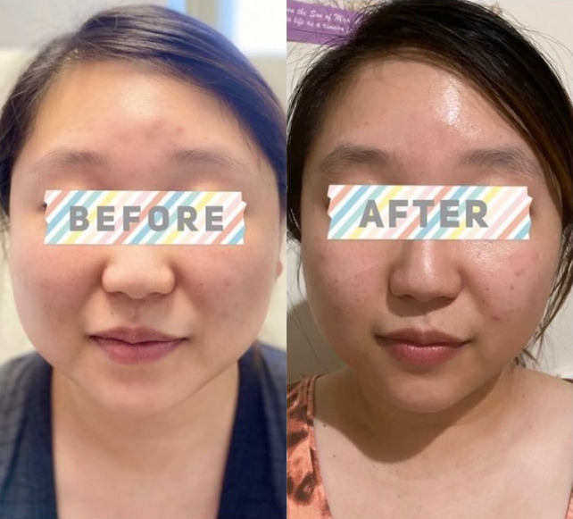 Masseter Reduction with Dysport Before and After Photo by Dr. James Y. Wang of Metropolis Dermatology in Los Angeles, CA